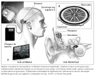 neuroprothese vestibulaire, gyroscope, implant, microprocesseur, mutli-capteurs, accéléromètres, axe angulaire, intégration de taux